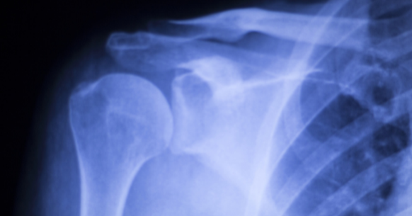 X-Ray shoulder
